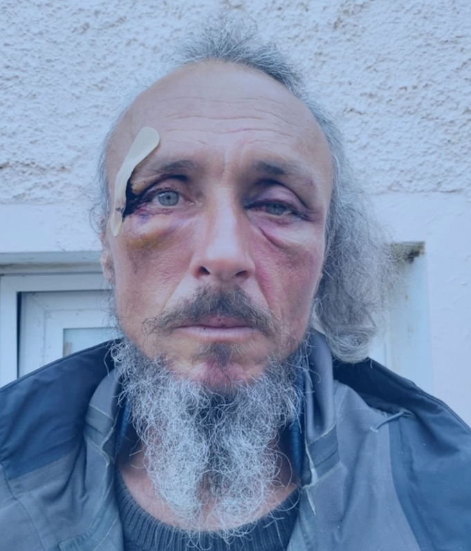 The face of Julien Blondel . . . bloodied but unbowed